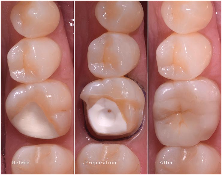 Onlay Before and After