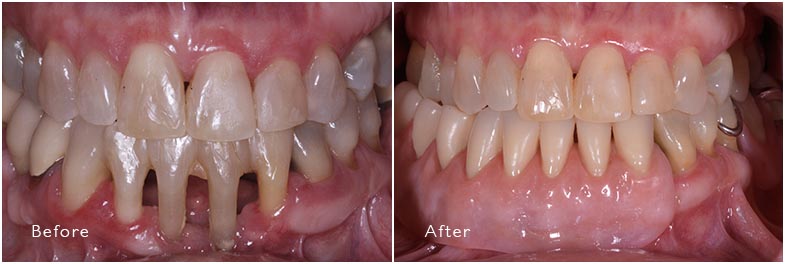 Partial Dentures Before and After