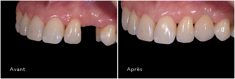 Resin Bonded Bridge Before and After