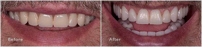 Complete Denture Before and After_en